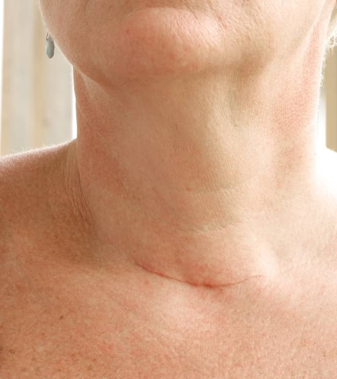 A smiling, senior woman with postoperative scar after thyroid surgery, close-up.