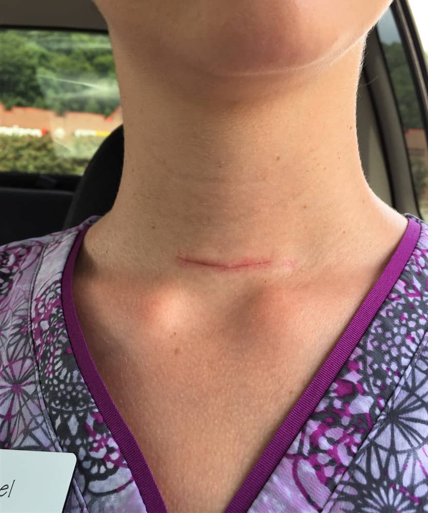 A close up of a woman's neck showing a scar from thyroid surgery.