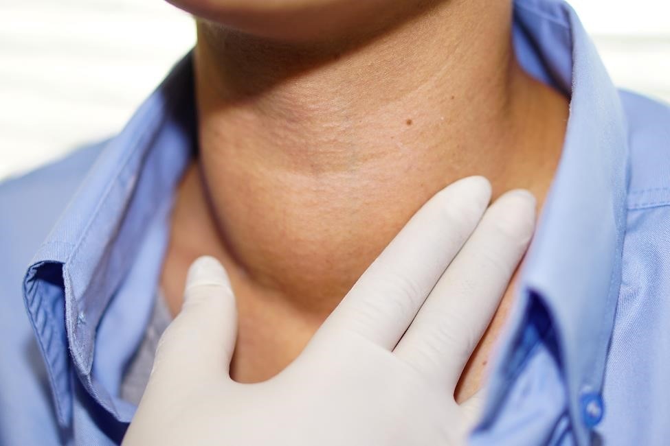 A person’s neck with a goiter. 