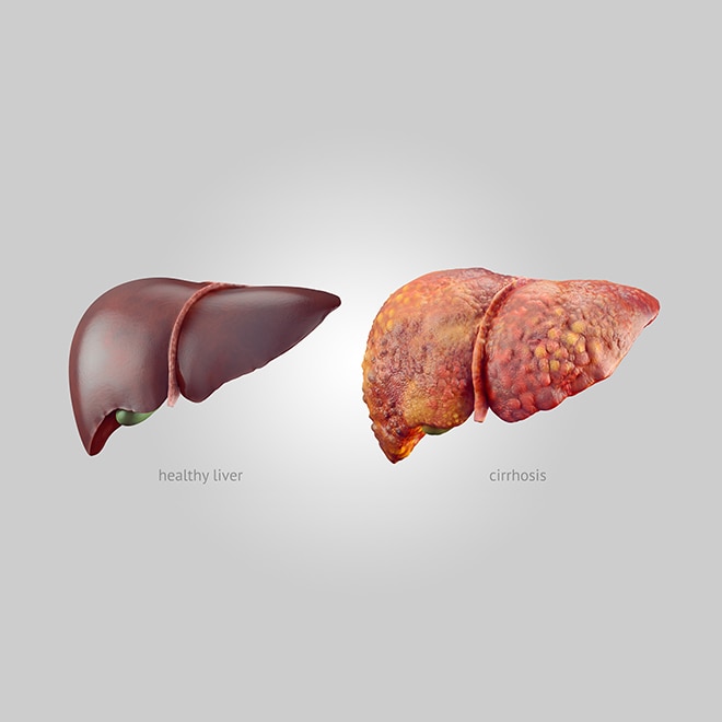 A healthy liver and a liver with cirrhosis.