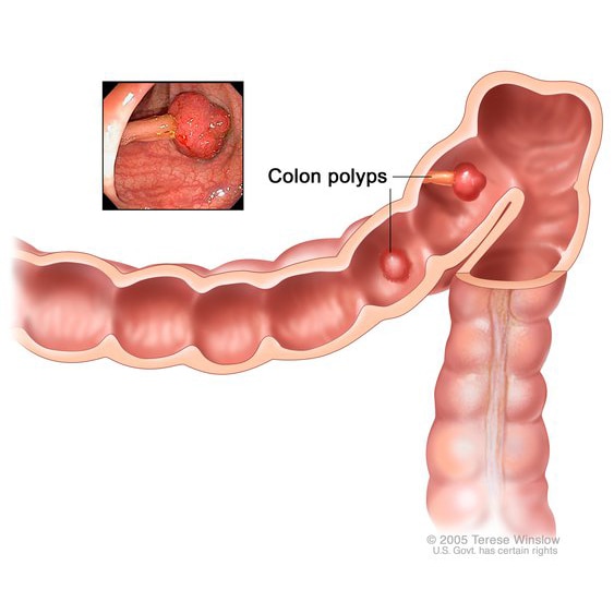 two polyps (one flat and one pedunculated) inside the colon