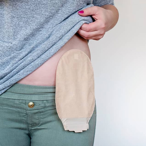 https://www.niddk.nih.gov/-/media/Images/Health-Information/Featured-Images/front-view-colostomy-pouch-skin_600x600.jpg?h=600&iar=0&w=600&hash=AAA6ED5AB9BCC6D74285EB84F2A1A0D9