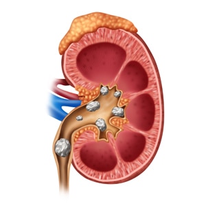 diagram of kidney stones (painful crystaline mineral formations) in the human kidney