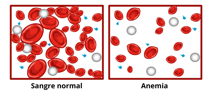 Imagen de glóbulos sanguíneos normales comparados con glóbulos sanguíneos anémicos.
