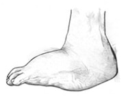 Illustration of Charcot's foot showing a roundish flare of the sole of the foot.