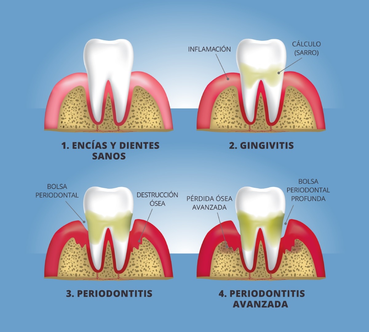 Ilustración en primer plano de un diente y encías, mostrando cuatro etapas de la enfermedad de las encías: (1) encías y diente sanos, (2) gingivitis, (3) periodontitis y (4) periodontitis avanzada. Las etiquetas señalan: inflamación, cálculo (sarro), bolsa periodontal, destrucción ósea, pérdida ósea avanzada y bolsa periodontal profunda.