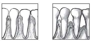 Drawing of a close-up view of a person's healthy teeth and gums. Drawing of a close-up view of the teeth and gums of a person with periodontitis.