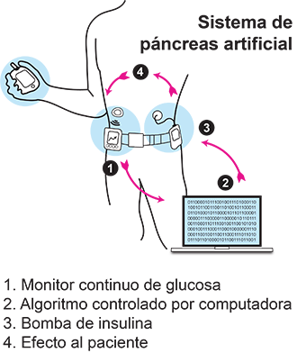 Dibujo de una persona que tiene puesto un sistema de páncreas artificial.