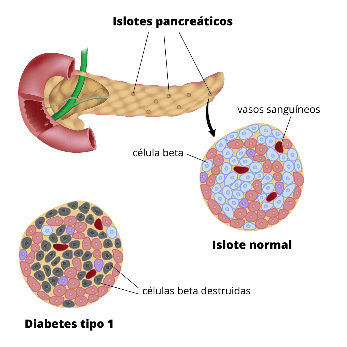 Ilustración del páncreas con insertos que muestra un islote normal, con muchas células beta sanas, y un islote de una persona con diabetes tipo 1, con muchas células beta destruidas.