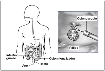 Tratamiento para los pólipos de colon - NIDDK