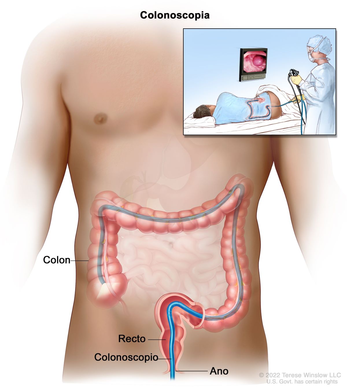 Colonoscopia: se introduce un colonoscopio por el ano y a través del recto y el colon. El recuadro muestra a un profesional de atención de salud que realiza una colonoscopia a un paciente acostado de lado.