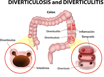 Ilustración de los dos puntos con la inflamación, sangrado, la diverticulosis y la diverticulitis
