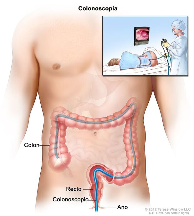 Ilustración de un torso y encima de esa ilustración, una ilustración de un médico haciendo una colonoscopia.