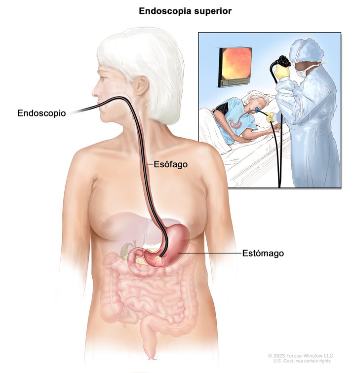Endoscopia gastrointestinal superior: se introduce un endoscopio (un tubo delgado e iluminado) por la boca y la garganta hasta el esófago y el estómago. El recuadro muestra a un profesional de atención de salud que realiza una endoscopia gastrointestinal superior a un paciente acostado de lado.