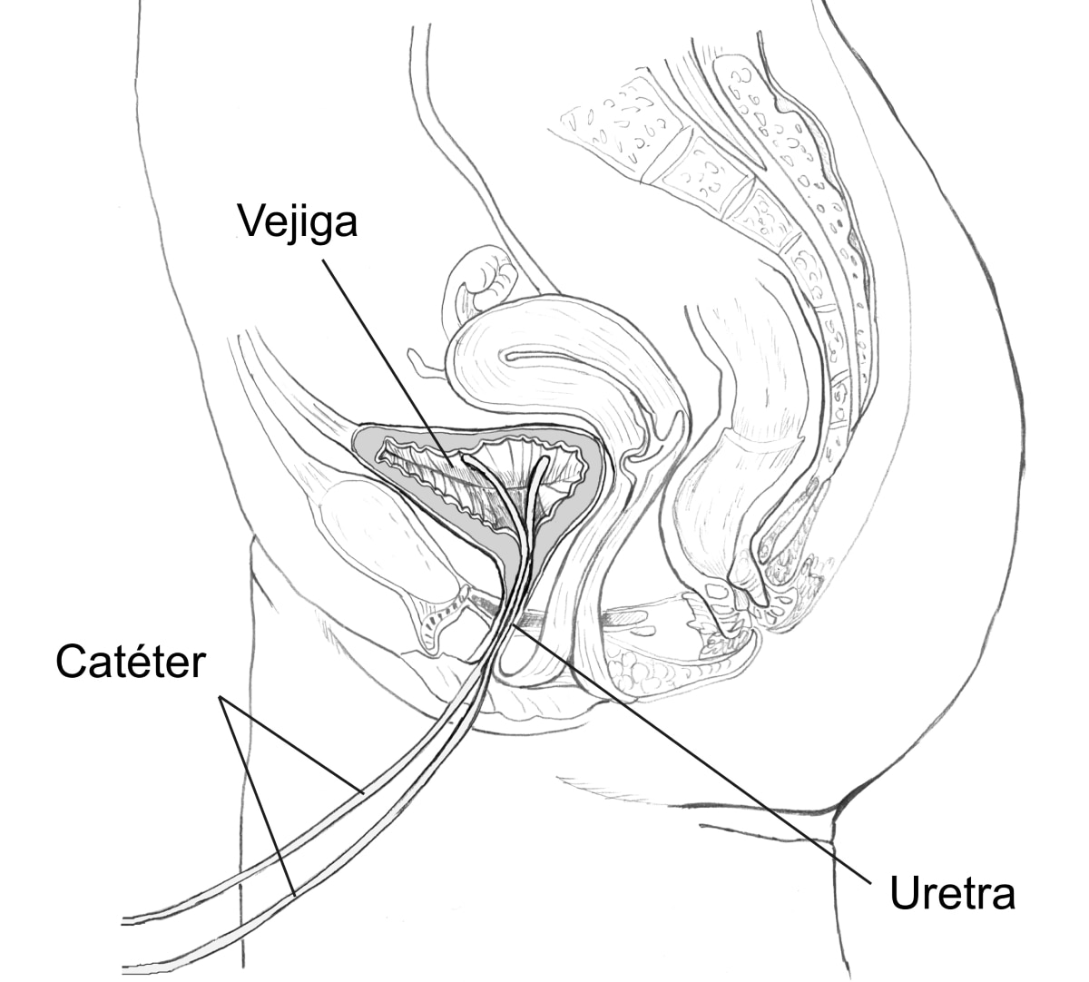 Dibujo de una vista lateral de las vías urinarias femeninas con catéteres insertados a través de la uretra hasta la vejiga. Los catéteres, la uretra y la vejiga están etiquetados.
