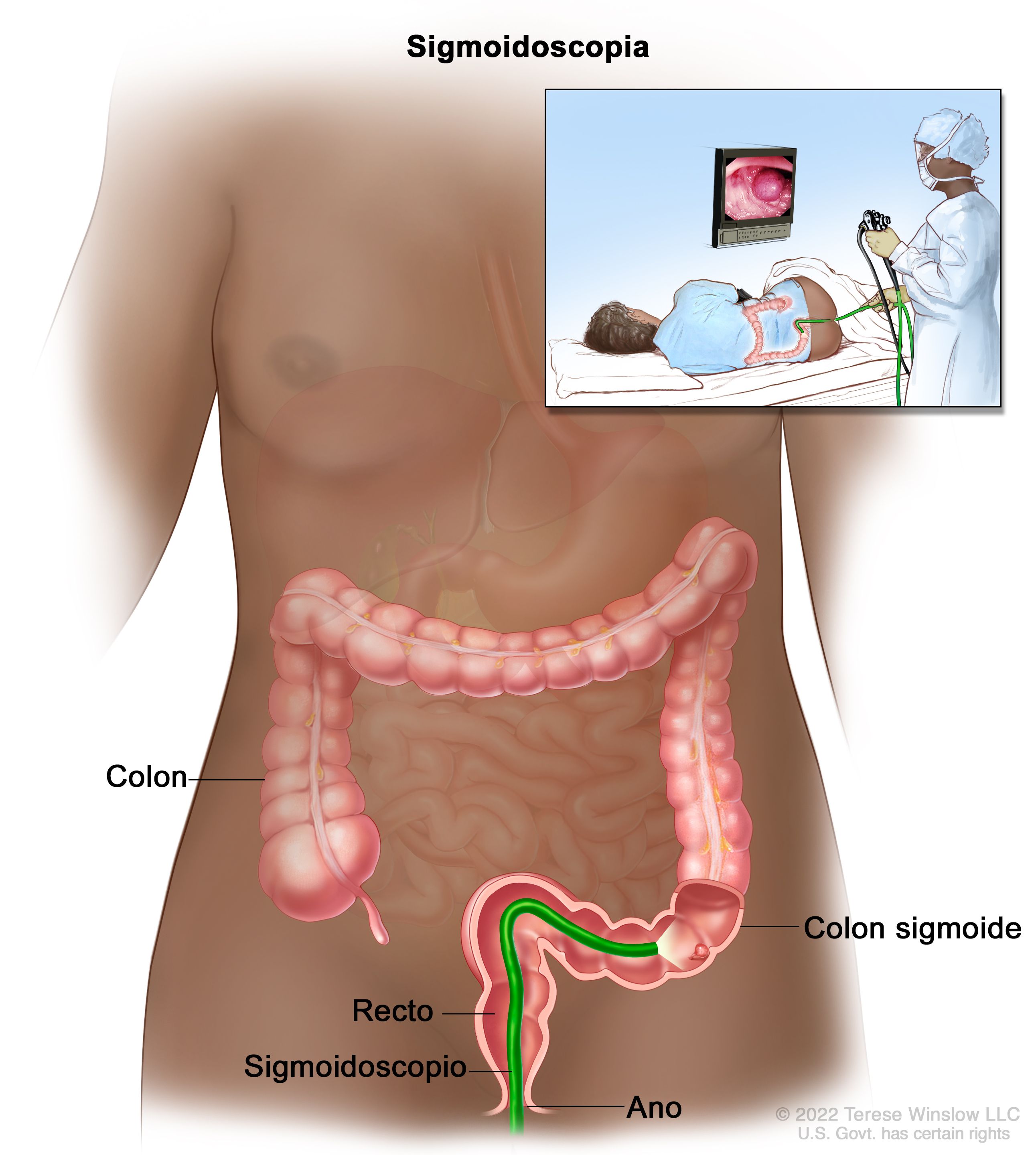 Un sigmoidoscopio introducido a través del ano, el recto y la parte inferior del colon. En el recuadro se ve a una profesional de atención de salud que realiza una sigmoidoscopia flexible y una paciente acostada de lado.