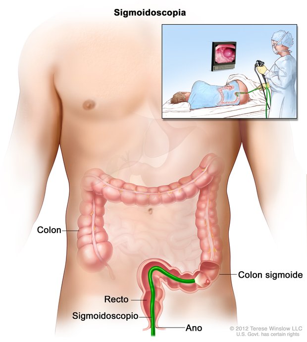 Ilustración del procedimiento de sigmoidoscopia flexible.