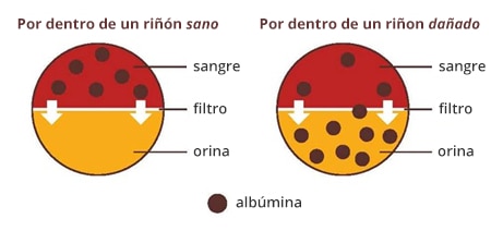 Diagrama que muestra un riñón sano que solo tiene albúmina en la sangre y un riñón dañado que tiene albúmina tanto en la sangre como en la orina.
