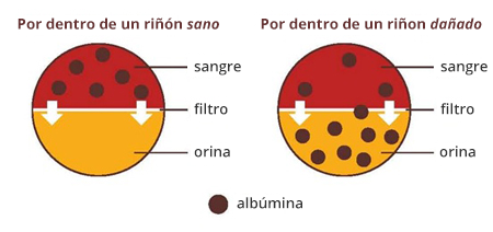 Diagrama que muestra un riñón sano que solo tiene albúmina en la sangre y un riñón dañado que tiene albúmina tanto en la sangre como en la orina.