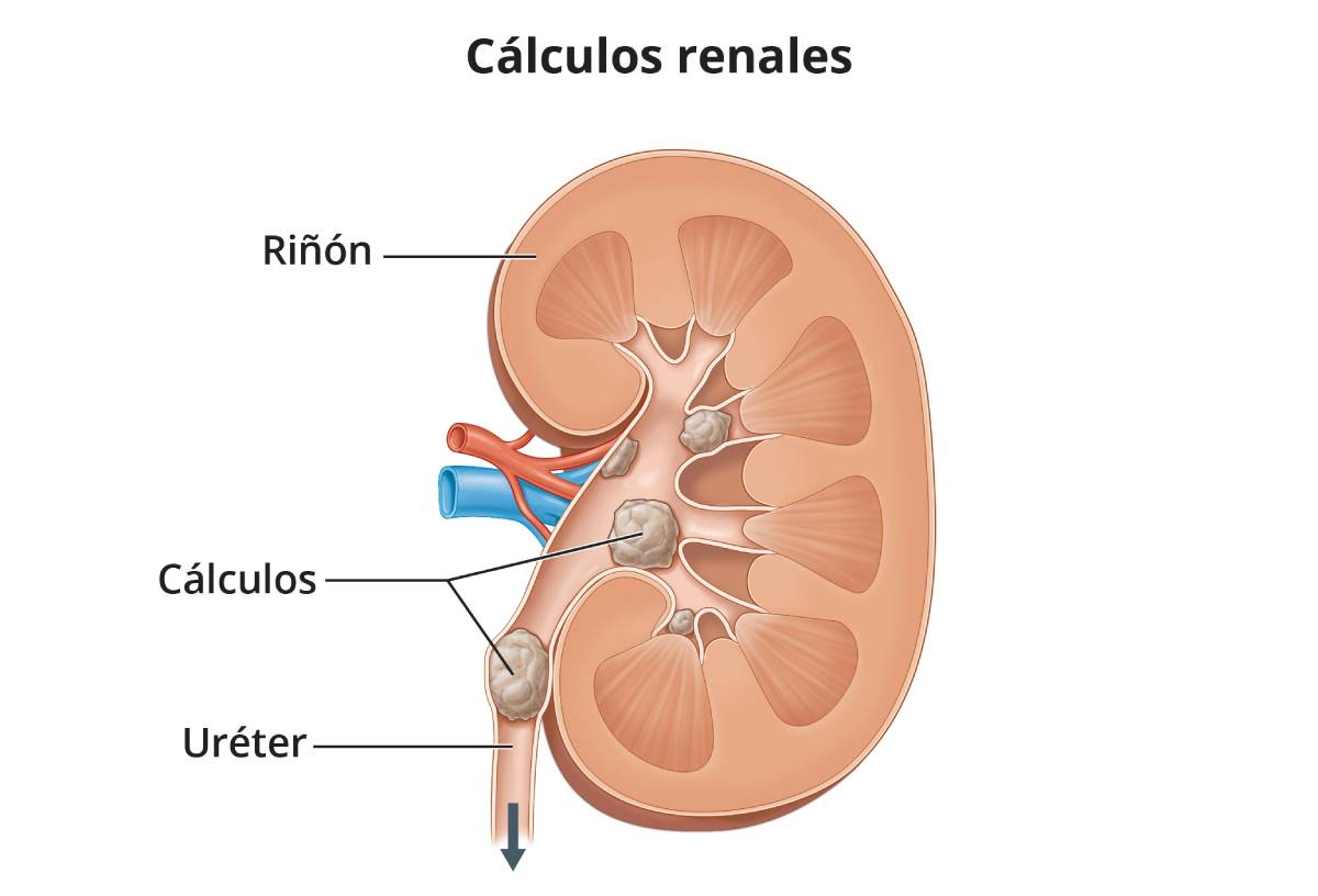 Un riñón humano con varios piedras en los riñones que bloquean las vías urinarias.
