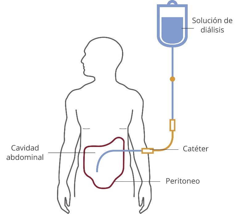 腹膜透析図は、腹腔内に入るカテーテルに接続された透析液の袋を示しており、腹膜の輪郭も示しています。