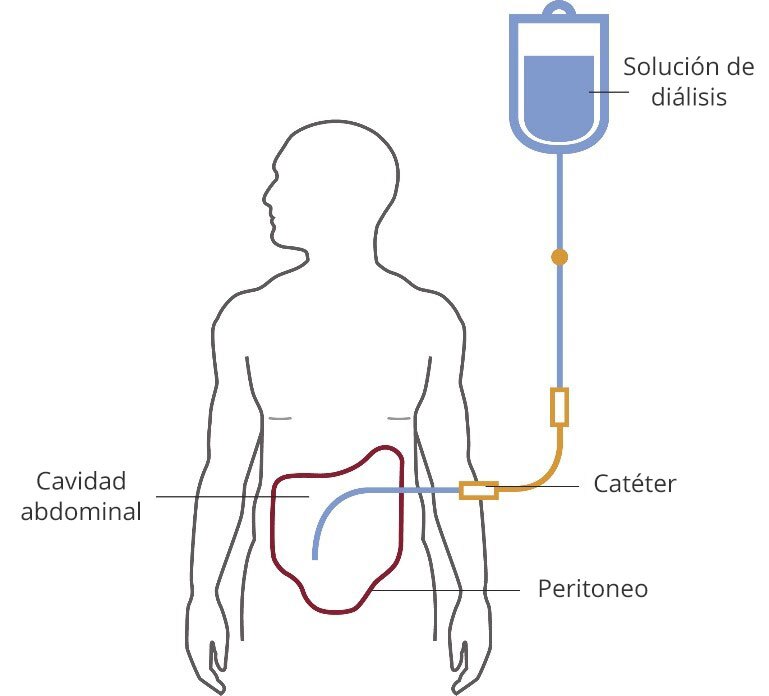 Diálisis peritoneal | NIDDK