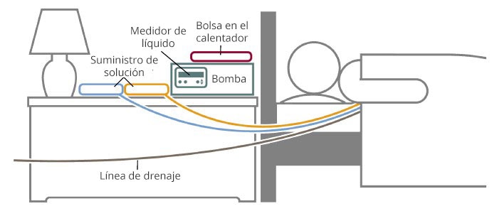  Dessin d'une personne allongée à côté d'une table de chevet avec un sac chauffant, un compteur de liquide, une pompe et deux sources d'approvisionnement en solution. Les lignes relient les fournitures de solution à la personne. Une ligne de vidange est connectée à la personne et sort du cadre de dessin. 