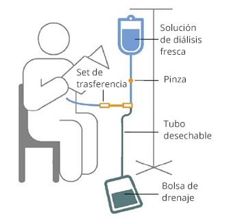  Dessin d'une personne lisant pendant une dialyse péritonéale ambulatoire continue. Un sac de nouvelle solution de dialyse est suspendu à un lutrin et se fixe à un tube muni d'une pince. Le tube est connecté à un ensemble de transfert, un tube jetable qui est connecté à un autre tube qui pénètre dans l'abdomen de la personne. Le tube est également connecté de l'ensemble de transfert au sac de drainage sur le sol.