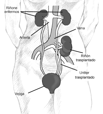 Un diagrama que muestra la localización de un ri~ón donado en la parte inferior del abdomen. Los ri~ones enfermos se quedan en la parte superior del abdomen. Las etiquetas se~alan a los ri~ones enfermos, la arteria, la vena, el ri~ón trasplantado, el uréter trasplantado y la vejiga.