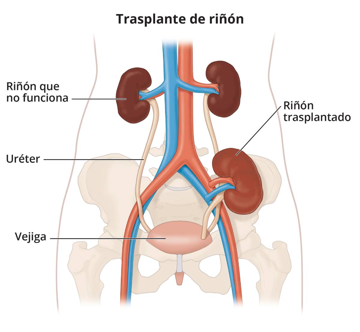 Un diagrama que muestra la localizacion de un rinon donado en la parte superior del abdomen. Las etiquetas senalan a los rinones, la arteria, la vena, el rinon transplantado, el ureter transplantado y la vejiga.