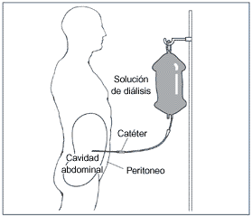 Un diagrama de un paciente recibiendo diálisis peritoneal. Las etiquetas se~alan la solución de diálisis, el catéter, el peritoneo y la cavidad abdominal. La solución de diálisis gotea mediante el catéter hacia una bolsa de plástico en la cavidad abdominal.