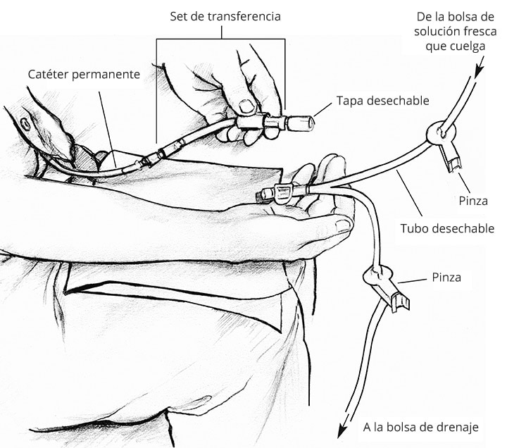 Primer plano de un set de transferencia. El catéter permanente se conecta al set de transferencia, que tiene una tapa desechable. El tubo desechable en forma de Y tiene una ramificación que viene de una bolsa de solución fresca que cuelga y una que va a una bolsa de drenaje. Ambas ramificaciones tienen pinzas.