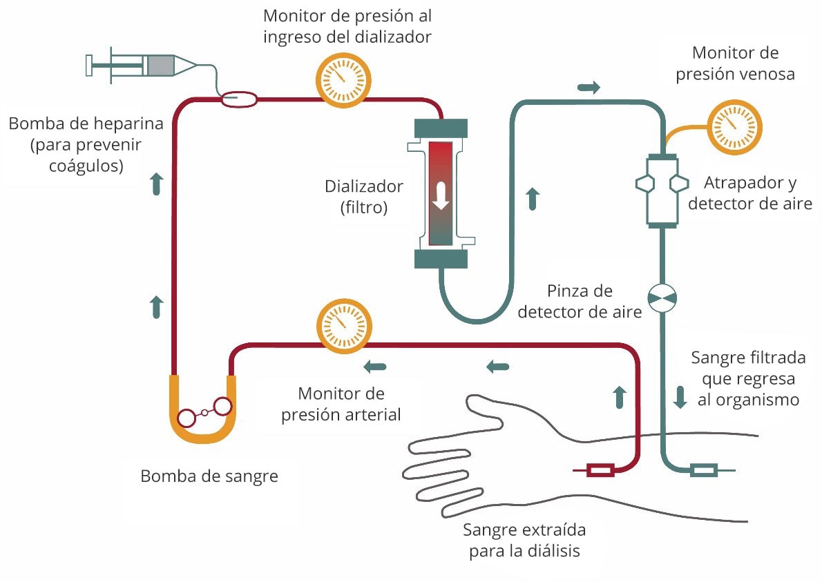 Diagrama del flujo sanguíneo durante la hemodiálisis desde el brazo hacia el tubo, pasando por un monitor de resión, una bomba de sangre y una bomba de heparina, que evita la coagulación. La sangre fluye pasando por otro monitor de presión antes de ingresar al dializador o filtro. La sangre filtrada continúa pasando por un monitor de presión venosa, un atrapador y un detector de aire, y una pinza de detector de aire, y regresa al brazo.