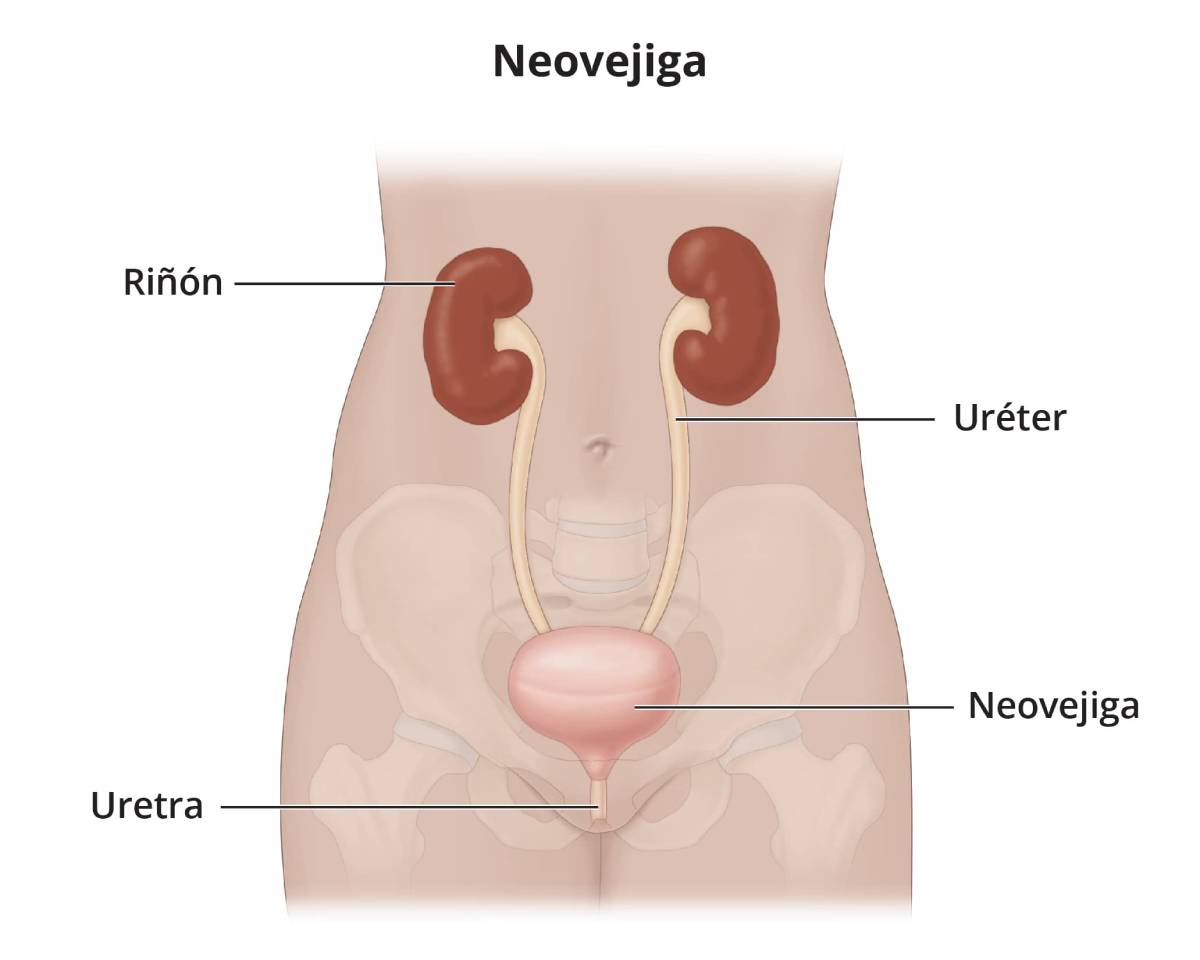 Los uréteres se adhieren a un sustituto de la vejiga y el sustituto de la vejiga se vacía a través de la uretra.