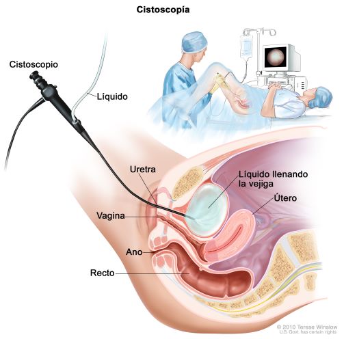 Illustration of a cystoscopy.  The cross section shows the cystoscope inserted into the urethra.  Fluid flows from a bag through the cystoscope to fill the bladder.  The cross section shows the uterus, vagina, anus, and rectum.