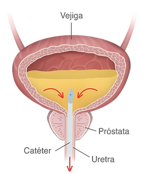 Una vejiga llena de orina con un catéter insertado a través de la uretra, con flechas que muestran el flujo de orina que sale de la vejiga a través del catéter.