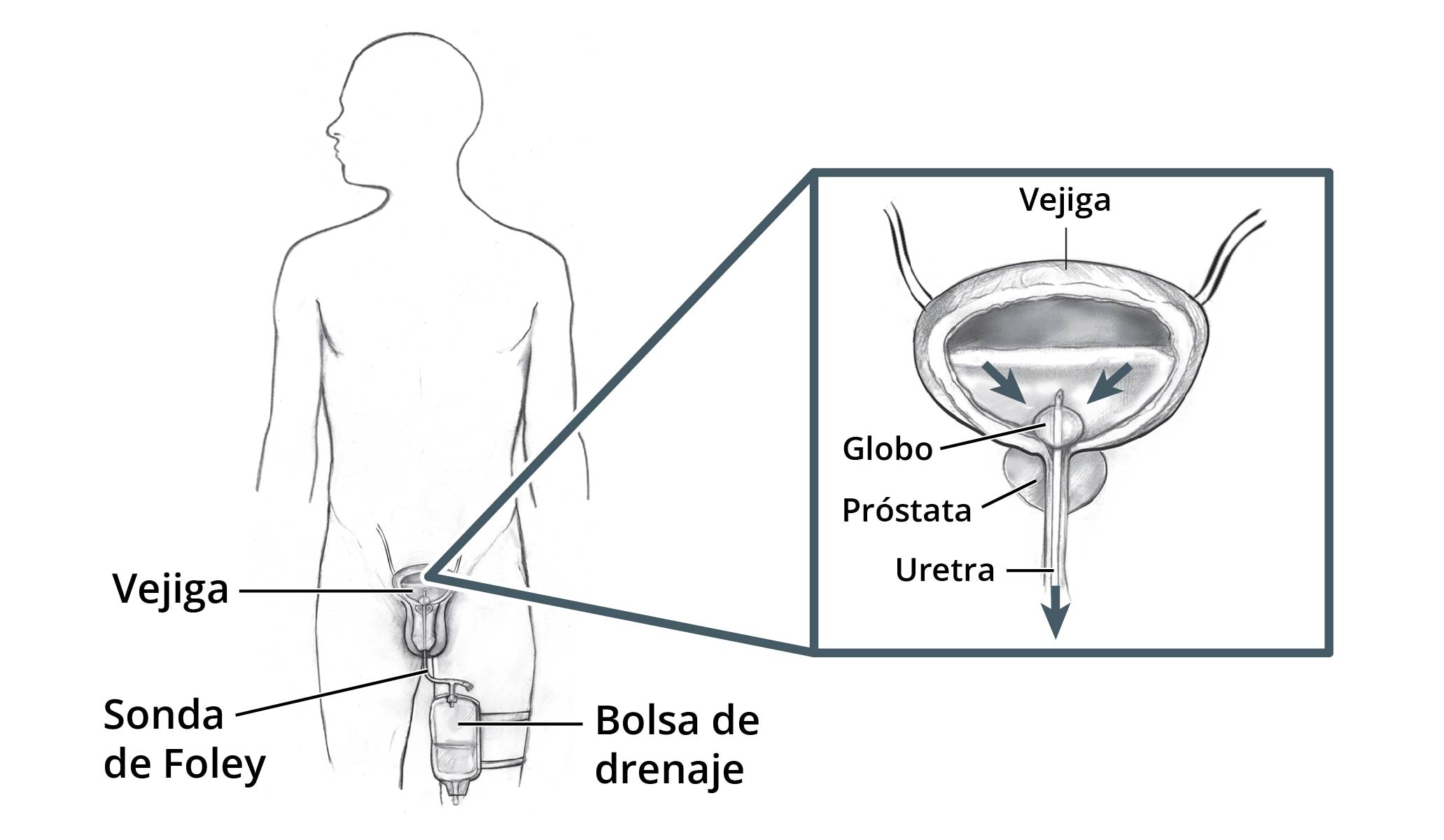 Esquema del cuerpo de un hombre que muestra una sonda de Foley insertada en la vejiga. Una bolsa de drenaje está sujeta al muslo. Un recuadro muestra más de cerca la salida de orina de la vejiga a través de la sonda. La sonda se mantiene en su lugar por medio de un globo.