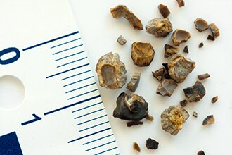 Tratamiento Para Las Piedras En Los Rinones Niddk