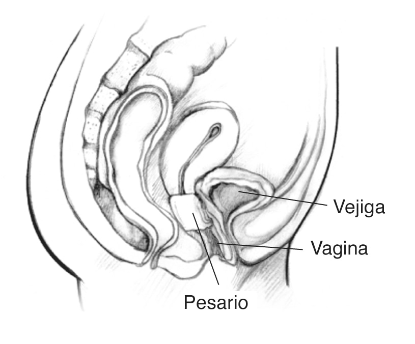 Un pesario insertado en la vagina para sostener la vejiga.