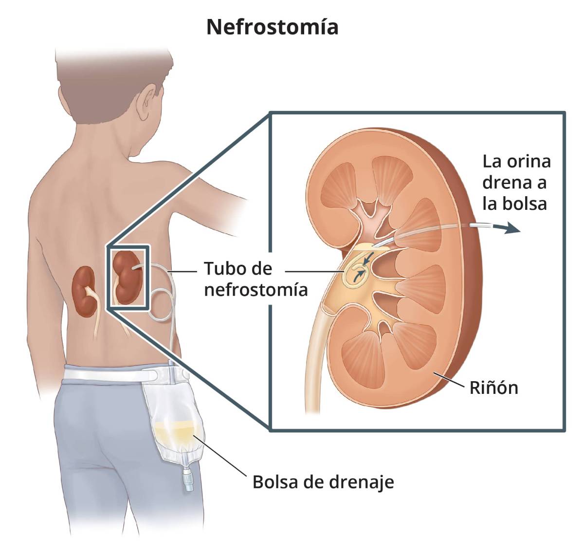 Un tubo de nefrostomía insertado en el riñón a través de la espalda del paciente y conectado a una bolsa de drenaje externa.