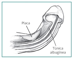 Sección transversal de un pene que muestra la curvatura causada por una placa durante la erección