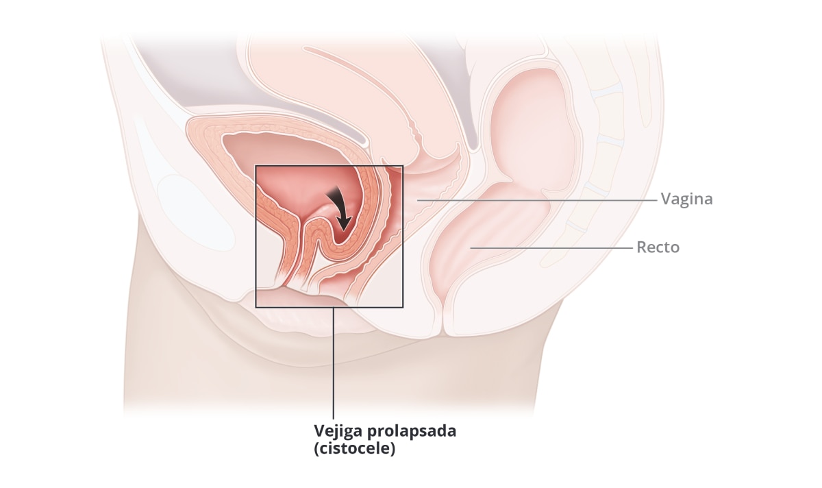 Cistocele