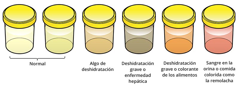 Una serie de muestras de orina. La orina de color claro es normal; amarillo intenso sugiere deshidratación; marrón oscuro o naranja sugiere una deshidratación grave o enfermedad hepática; rosa sugiere sangre en la orina o haber comido remolacha. Un color extraño puede deberse a la ingesta de alimentos con mucho colorante.  