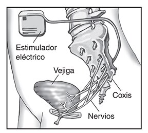 Dibujo anatómico que muestra la colocación del implante de un aparato de estimulación de los nervios en la parte baja del abdomen de una paciente mujer. Se señala el estimulador eléctrico, la vejiga, el coxis y los nervios.