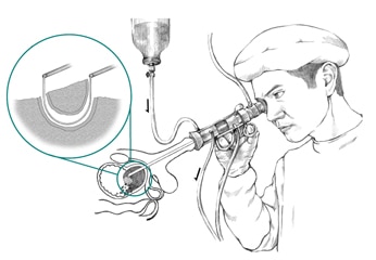 Ilustración de un médico realizando una resección transuretral de la próstata (TURP, por sus siglas en inglés). Una toma agrandada muestra una vista microscópica de un asa de alambre cortando tejido de la próstata.