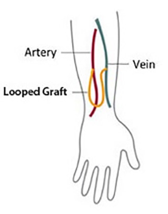 رسم الوريد والشريان في ذراع متصل بواسطة طعم ملتف.