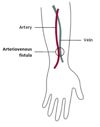 Drawing of an arm shows arteriovenous fistula connecting an artery and vein.