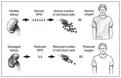 Top: process of normal red blood cell production with a healthy kidney. Bottom: process of reduced red blood cell production with a damaged kidney.