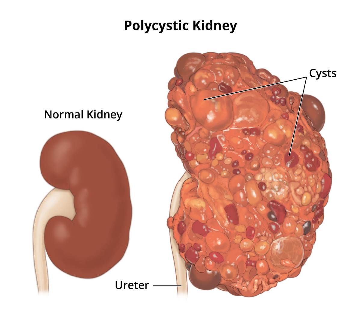 An illustration of a normal kidney and a polycystic kidney.