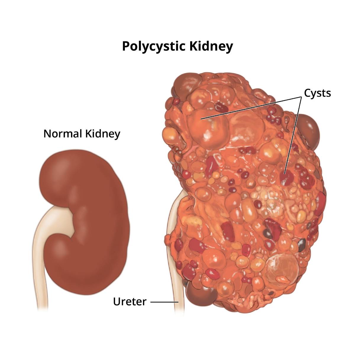 An illustration of a normal kidney and a polycystic kidney.